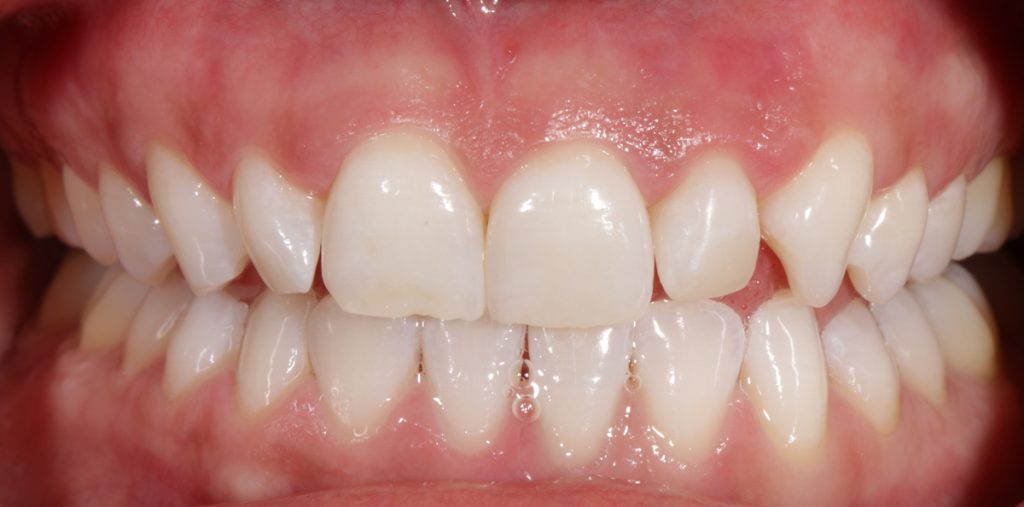 blanqueamiento dental casos