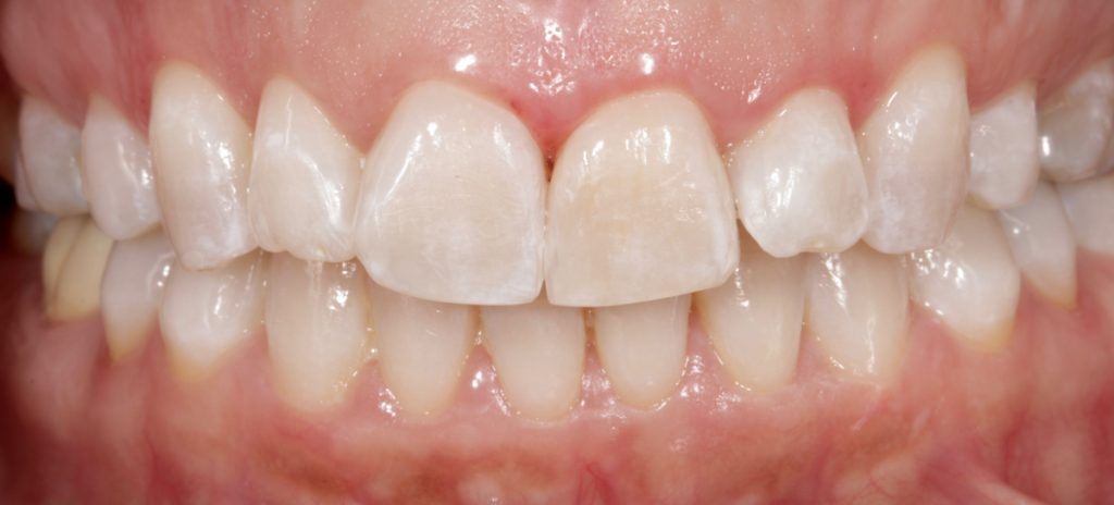 blanqueamiento dental casos