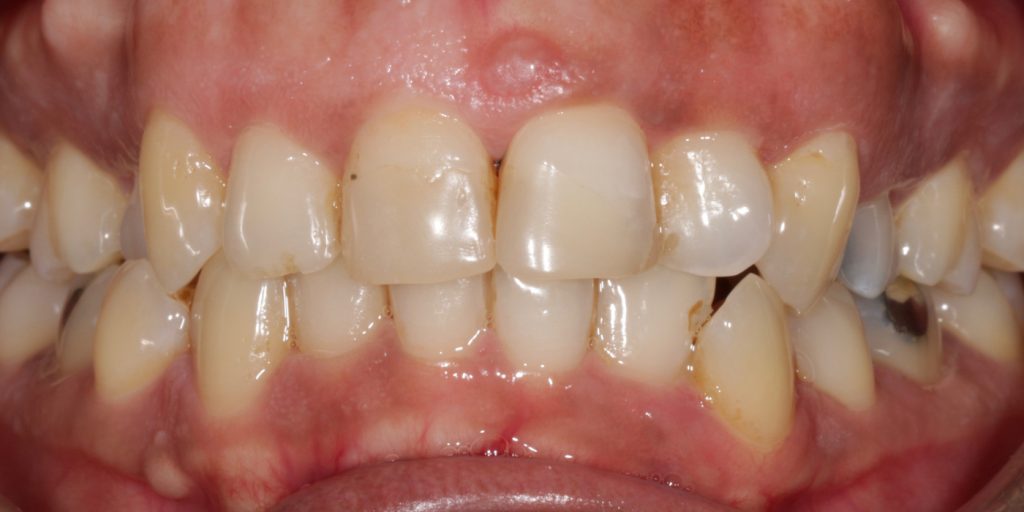 ortodoncia invisible antes y despues