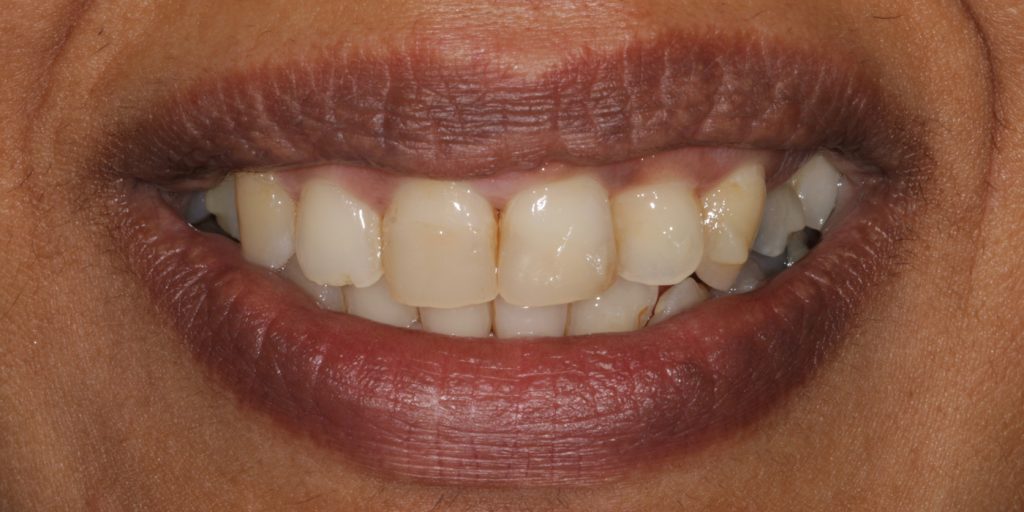 ortodoncia invisible antes y despues