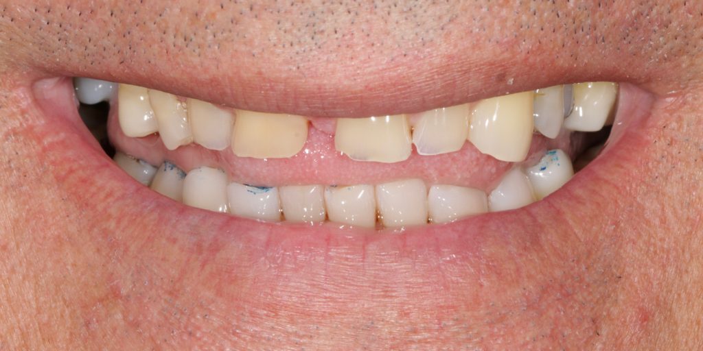 ortodoncia invisible antes y despues