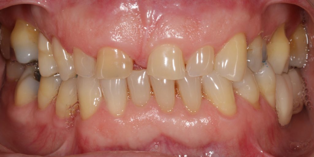 ortodoncia invisible antes y despues