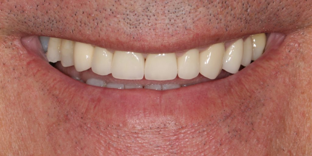 ortodoncia invisible antes y despues