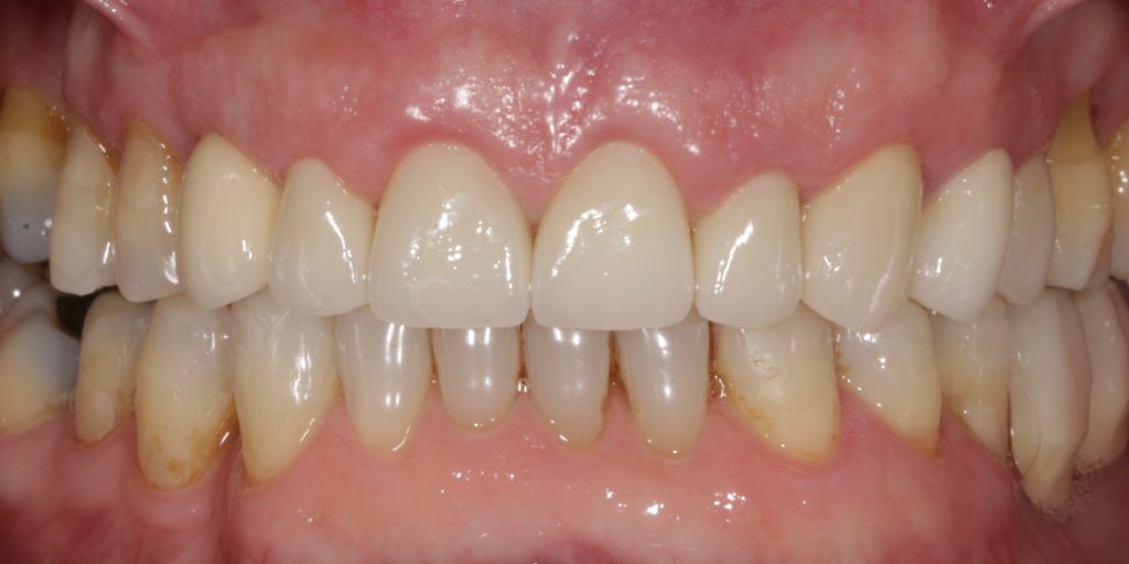 ortodoncia invisible antes y despues