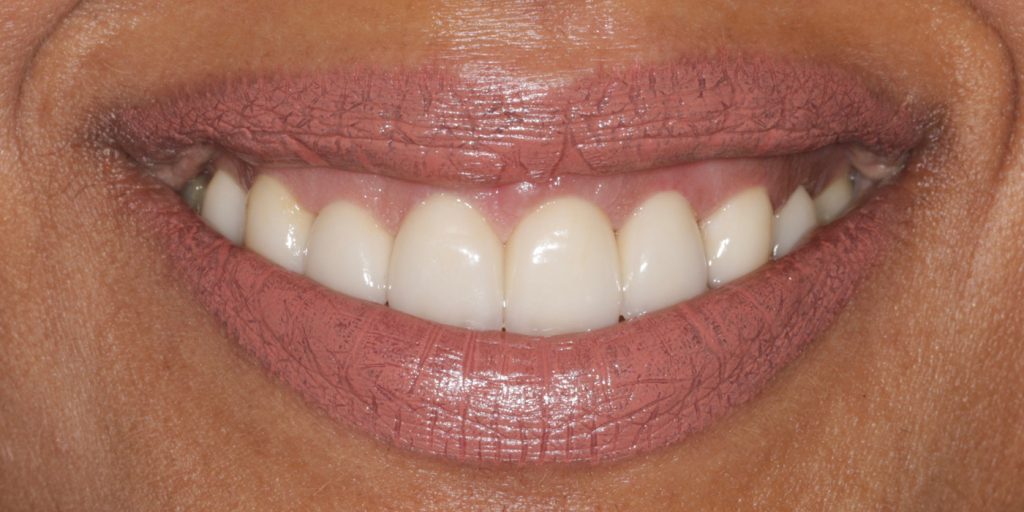 ortodoncia invisible antes y despues