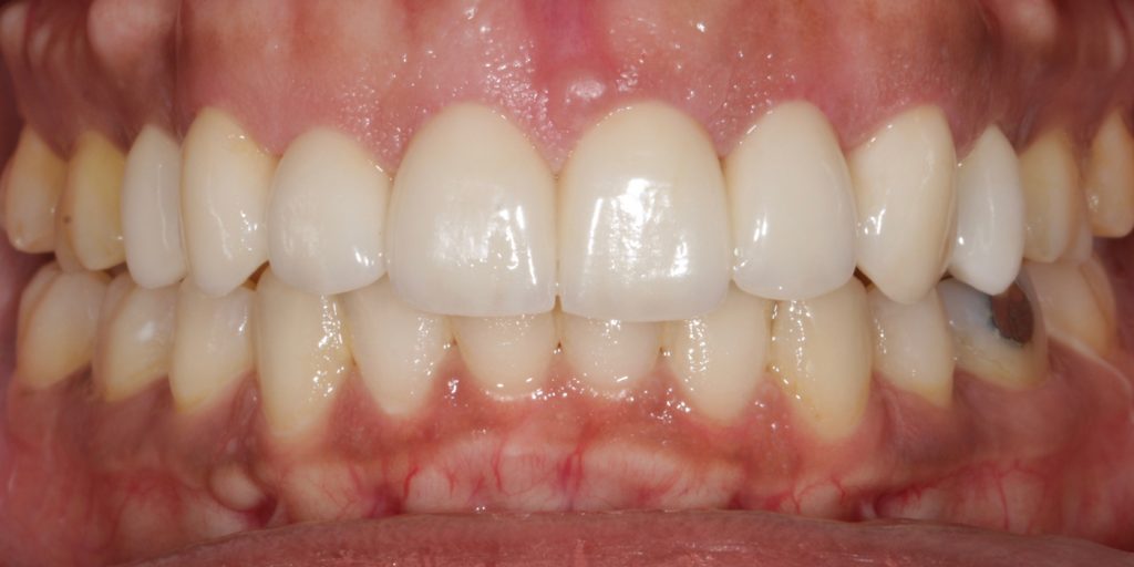 ortodoncia invisible antes y despues