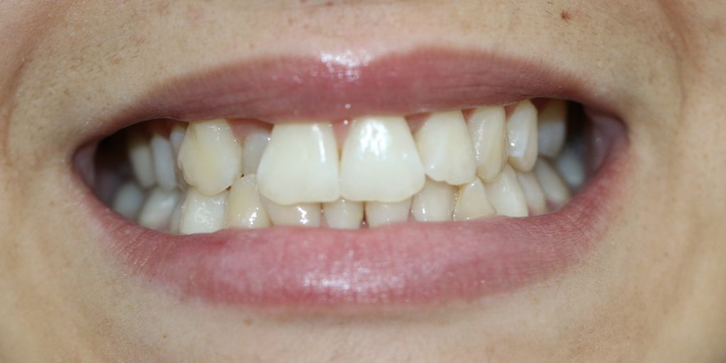 ortodoncia brackets