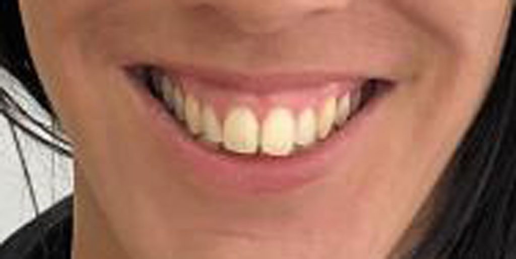 ortodoncia invisible antes y despues