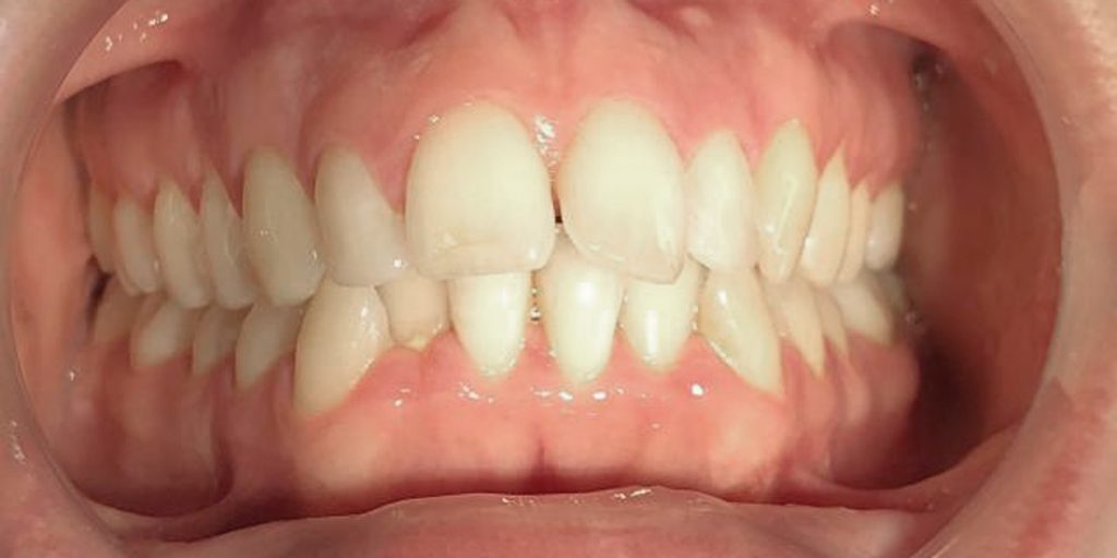 ortodoncia invisible antes y despues