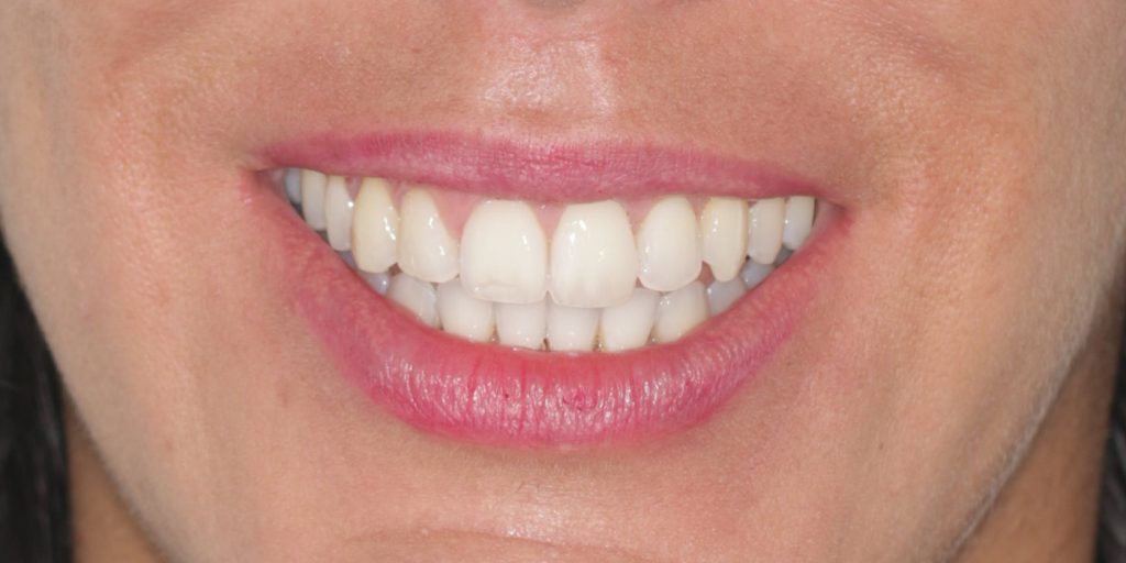 ortodoncia invisible antes y despues