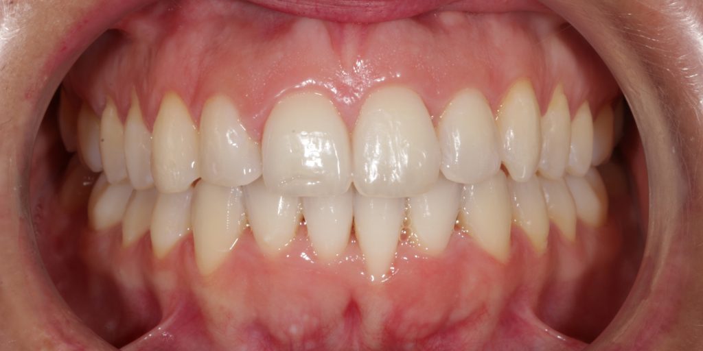 ortodoncia invisible antes y despues