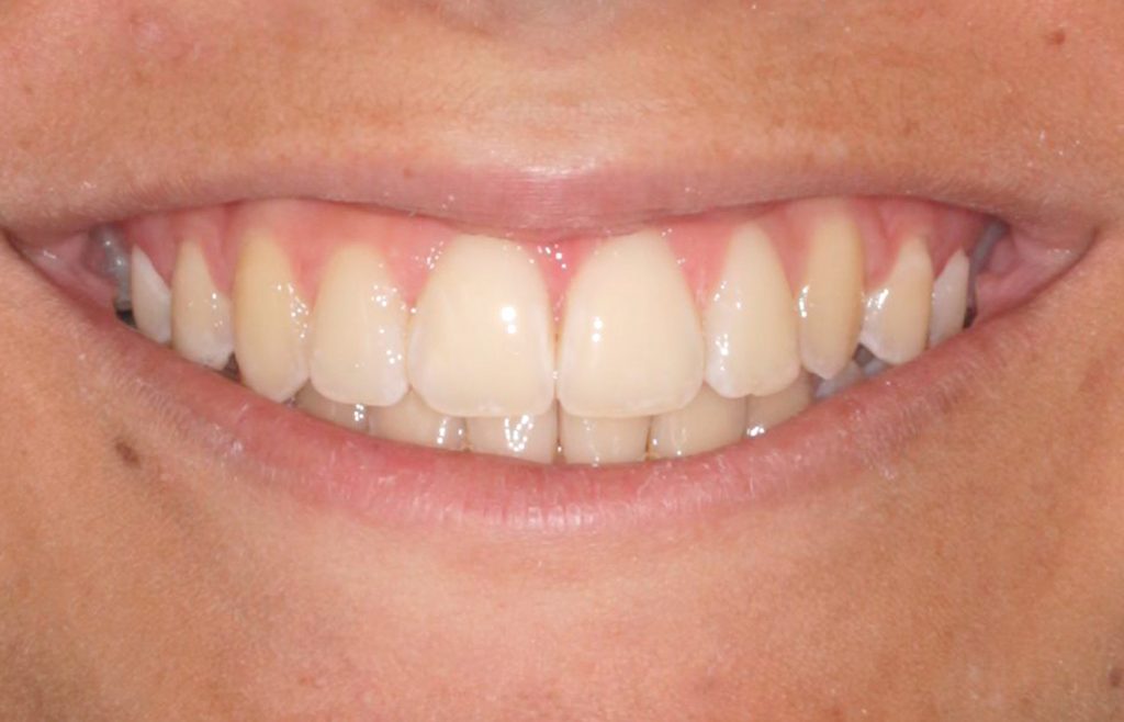 ortodoncia invisible antes y despues