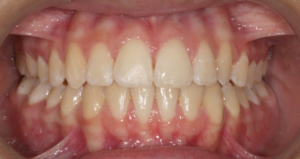 ortodoncia invisible antes y despues