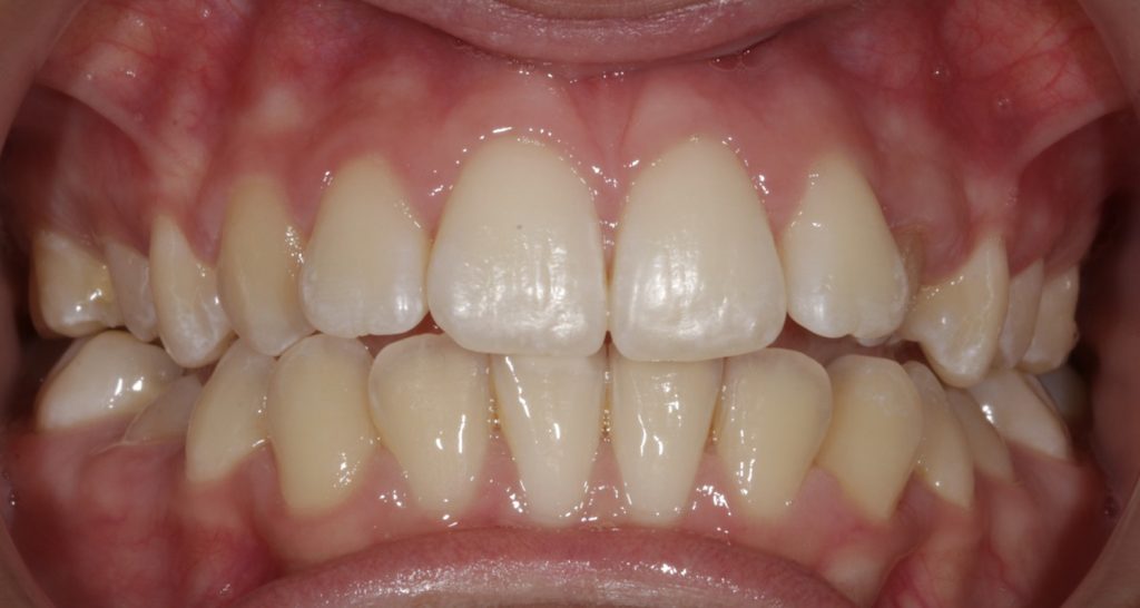 ortodoncia invisible antes y despues