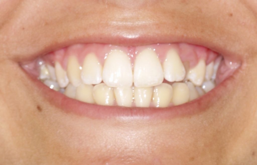ortodoncia invisible antes y despues