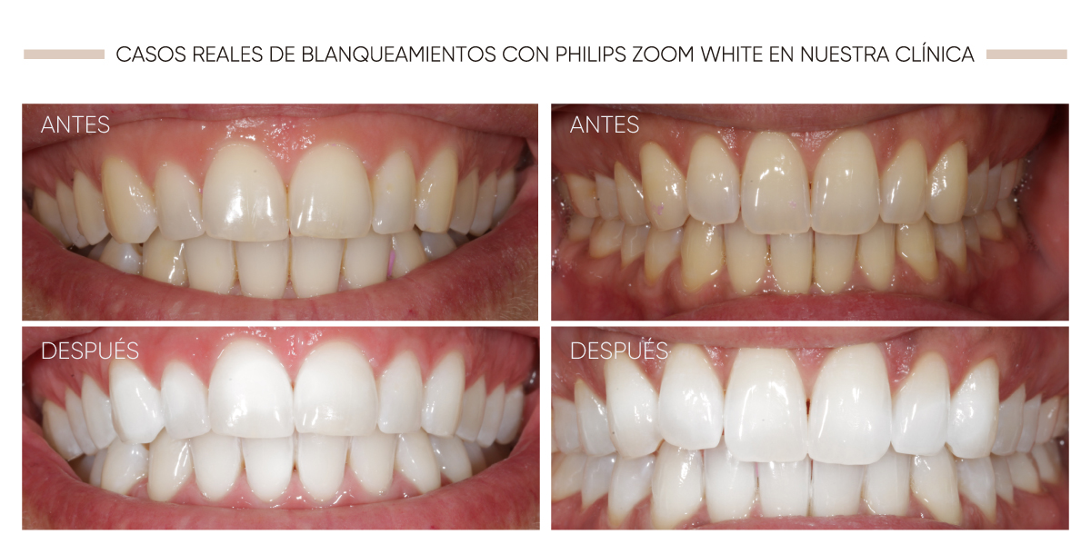 Blanqueamiento Dental Philips Zoom White