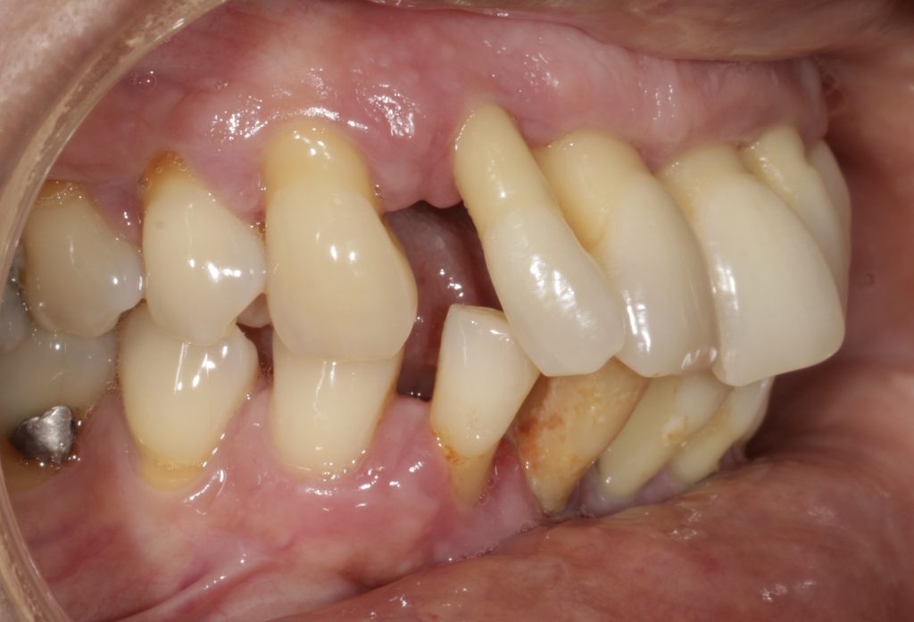 periodontitis covid