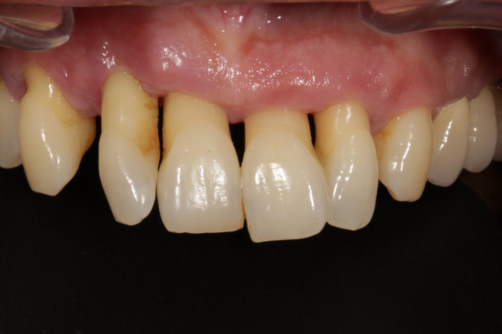 periodontitis covid